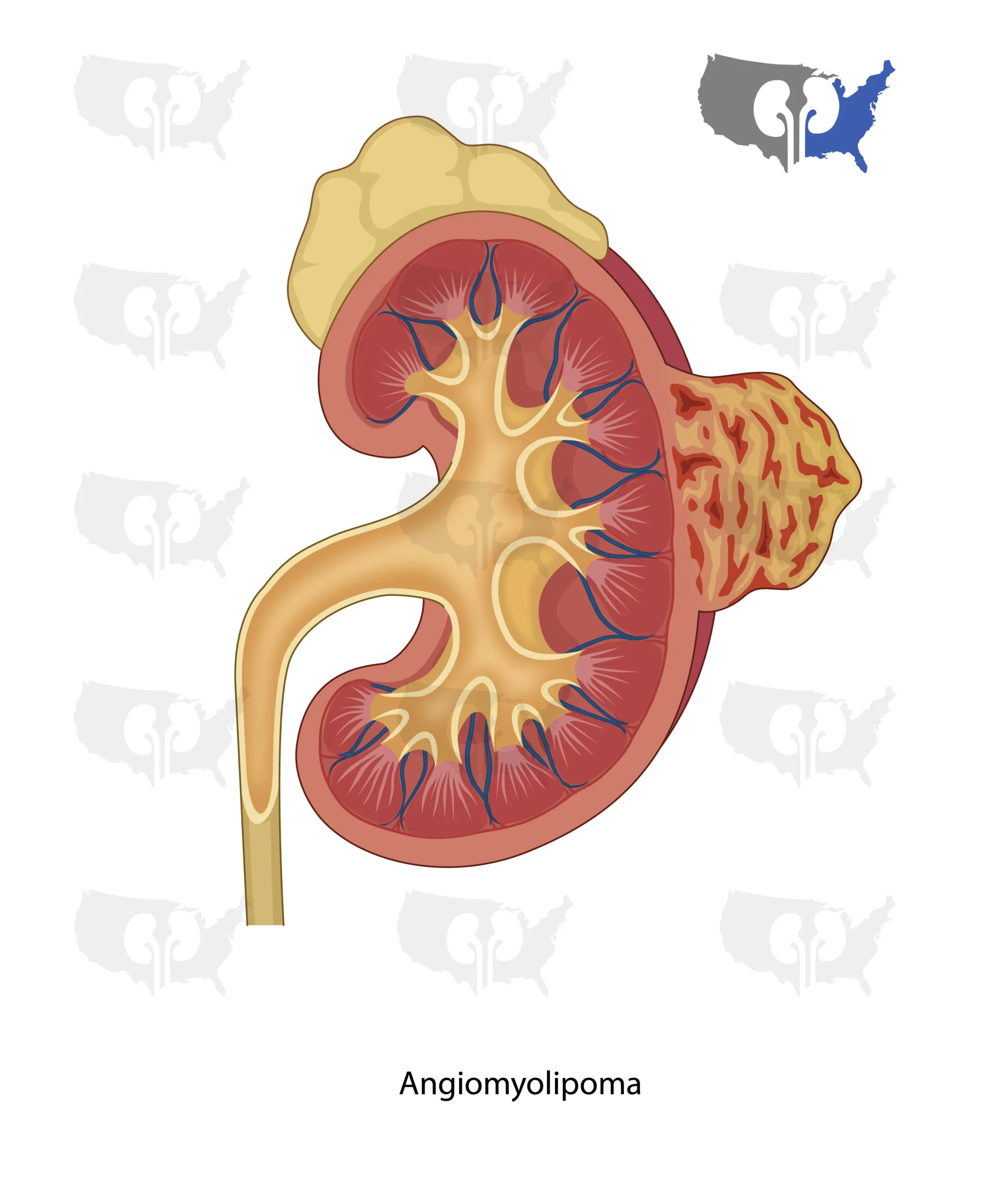 Angiomyolipoma