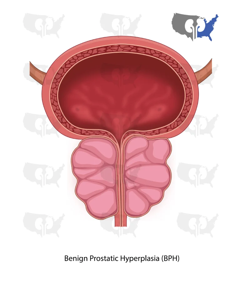 Benign Prostatic Hyperplasia