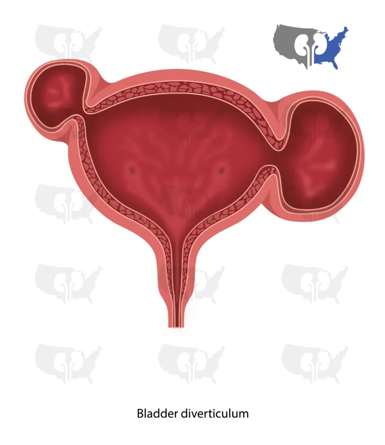 Bladder diverticulum