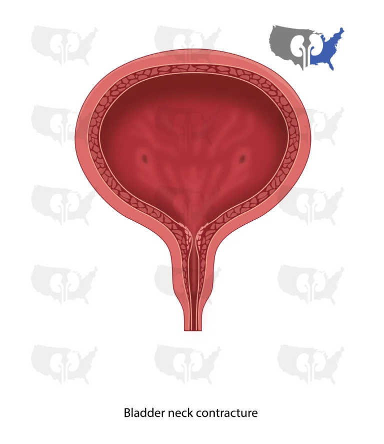 Bladder neck contracture