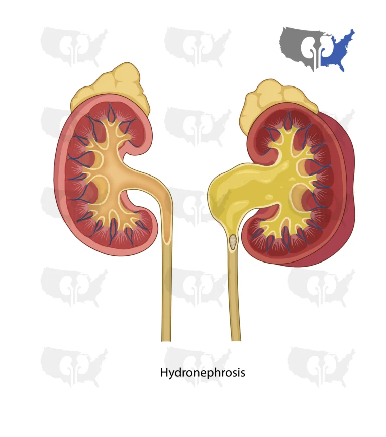 4 Hydronephrosis